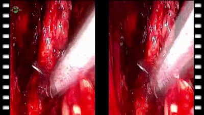 Видеоэндоскопическая экстрафасциальная радикальная простатэктомия. Тазовая лимфоаденэктомия (3D)