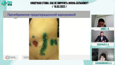 Леонтьев А.В. - Так делать не надо. Демонстрация клинический наблюдений «порочная кишечная стома»