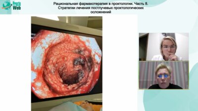 Терюшкова Ж.И. - Лечение постлучевых повреждений прямой кишки